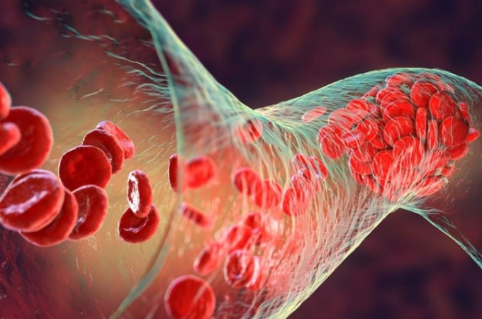Transfus�o in�dita de sangue criado em laborat�rio � realizada 