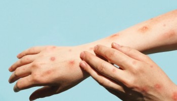 araraquara-registrou-1o-caso-da-doenca-mpox