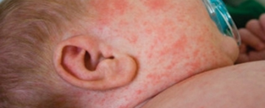 como-saber-se-e-sarampo